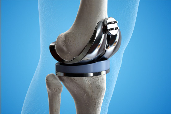 Expertise in joint replacement