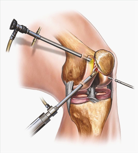 ORTHOPAEDICS JOINT REPLACEMENT SURGERY